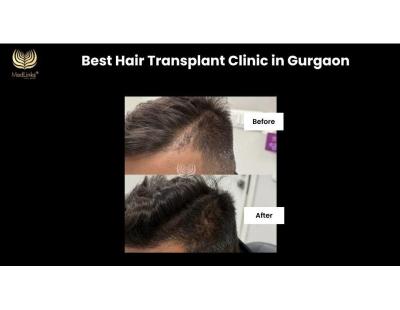 Advanced Hair Transplant Clinic in Gurgaon | MedLinks