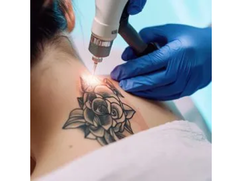 Advanced Tattoo Laser Treatment for Clear Skin | Amora Skin Beauty