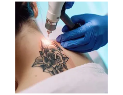 Advanced Tattoo Laser Treatment for Clear Skin | Amora Skin Beauty