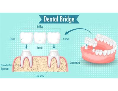 Dental Bridges Arizona – Restore Missing Teeth for Just $699 Per Unit