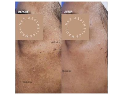 Get Expert Melasma Treatment in Gurgaon | Best Skin Clinic | MedLinks