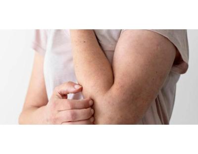 Get Expert Fungal Infection Treatment in Gurgaon | Estique Clinic