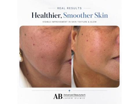 Beauty Clinic Melbourne | Advanced Beautytech Laser Clinic