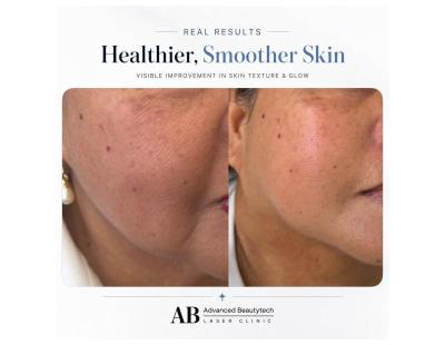 Beauty Clinic Melbourne | Advanced Beautytech Laser Clinic