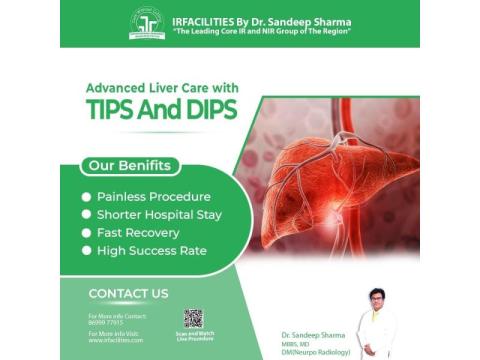 Transjugular Intrahepatic Portosystemic Shunt | Advanced TIPS Procedure