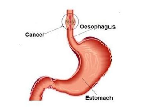 Esophageal Cancer Treatment in Noida | Expert Care by Dr. Manish Singhal
