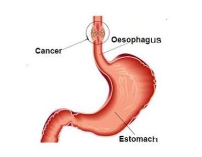 Esophageal Cancer Treatment in Noida | Expert Care by Dr. Manish Singhal