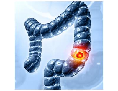 Expert GI Cancer Treatment in Noida | Dr. Manish Singhal