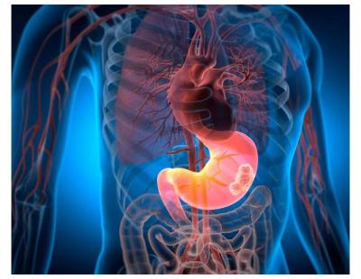 Stomach Cancer Treatment in Noida | Trusted Care by Dr. Manish Singhal