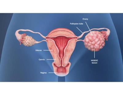 Best Ovarian Cancer Doctor in Noida | Dr. Manish Singhal