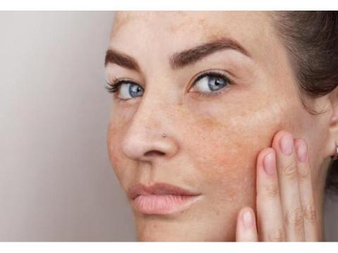 Get Clearer-Looking Skin with Pigmentation Treatment in Gurgaon