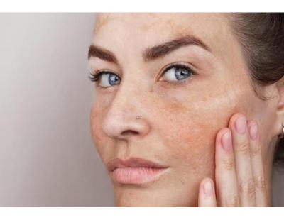 Get Clearer-Looking Skin with Pigmentation Treatment in Gurgaon
