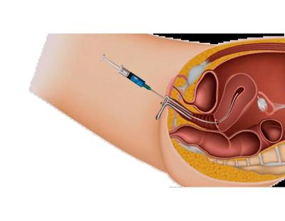 Start Your Parenthood Journey with IUI Treatment in Delhi