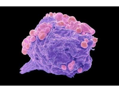 Advanced Lymphoma Cancer Treatment in Noida | Dr. Manish Singhal