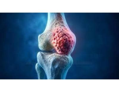 Expert Bone Cancer Treatment in Noida | Dr. Manish Singhal