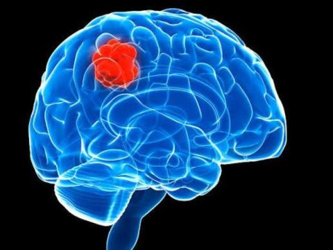 Advanced Brain Cancer Treatment in Noida | Dr. Manish Singhal
