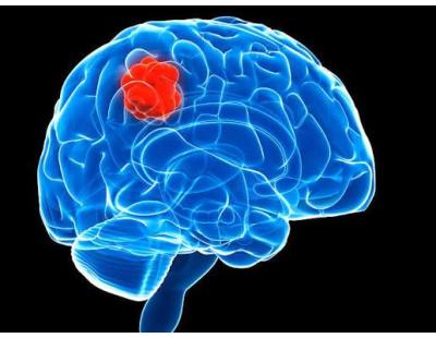 Advanced Brain Cancer Treatment in Noida | Dr. Manish Singhal