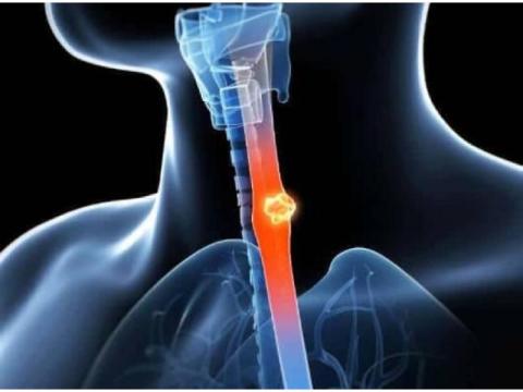 Expert Esophageal Cancer Doctor in Noida | Cancer Consult
