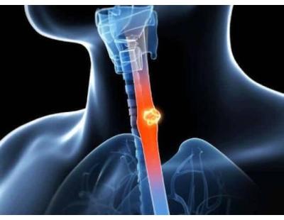 Expert Esophageal Cancer Doctor in Noida | Cancer Consult