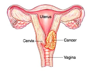 Advanced Cervical Cancer Care in Noida | Dr. Manish Singhal