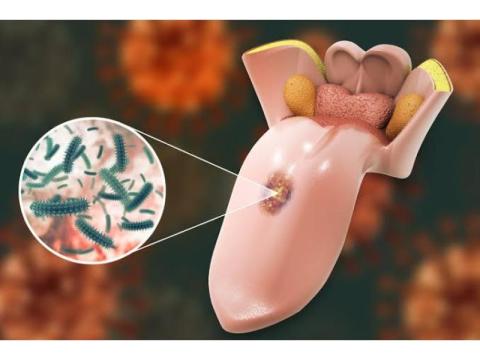 Trusted Oral Cancer Treatment in Noida – Dr. Manish Singhal
