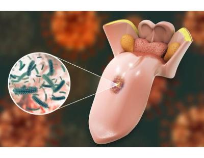Trusted Oral Cancer Treatment in Noida – Dr. Manish Singhal