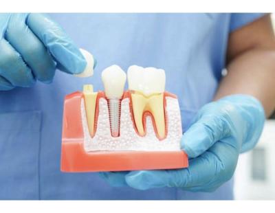 Dental Crowns in Mount Roskill, Auckland