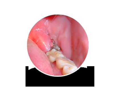 Best Wisdom Tooth Pain Extraction Services