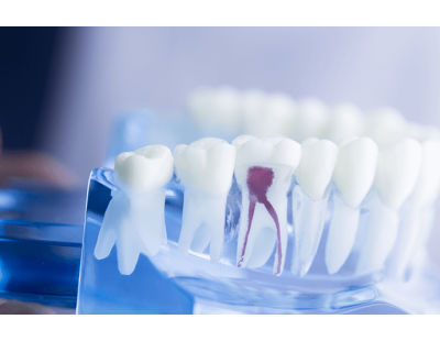 How Root Canal Treatment Relieves Tooth Pain and Saves Teeth