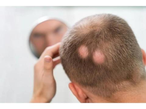 Alopecia Specialist Georgia | Hair Clinique Restoration Center