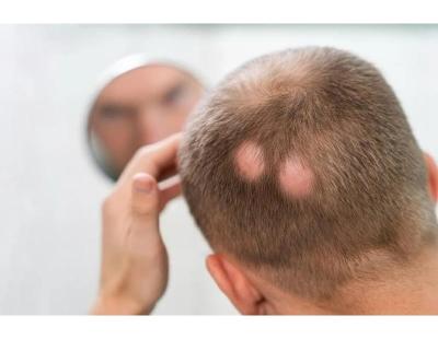 Alopecia Specialist Georgia | Hair Clinique Restoration Center