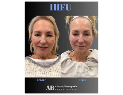 Hydrodermabrasion Balwyn | Advanced Beautytech Laser Clinic