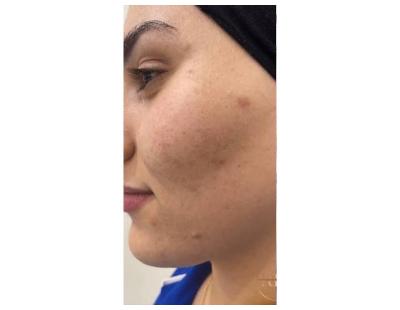 What Do SQT Bio Microneedling Reviews Say About Treatment?