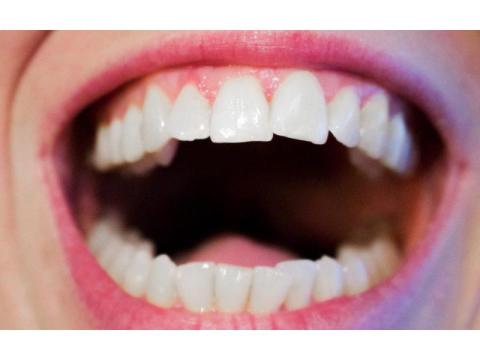 How Crowns Teeth Can Improve Your Smile and Oral Health