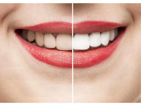 Teeth Whitening in Mount Roskill, Auckland