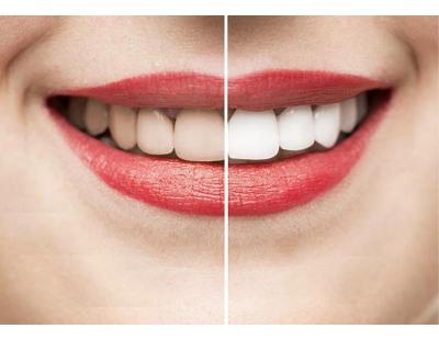 Teeth Whitening in Mount Roskill, Auckland