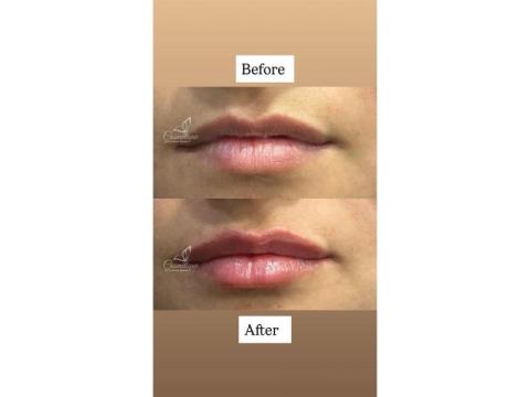 Lip Filler Treatment Near Me for Natural-Looking Lip Enhancement