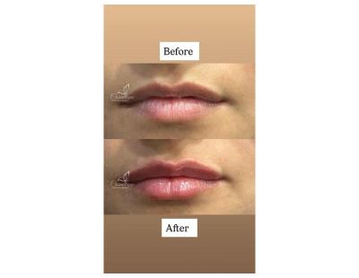 Lip Filler Treatment Near Me for Natural-Looking Lip Enhancement