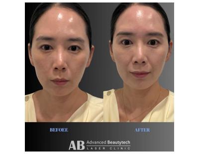 Hydrodermabrasion Balwyn | Advanced Beautytech Laser Clinic