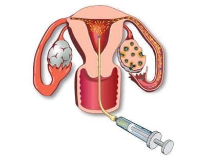 Intrauterine Insemination in Delhi | Expert Care at Fertylity IVF