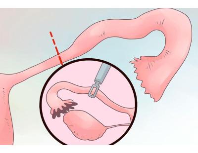 Percutaneous Epididymal Sperm Aspiration in Delhi | Fertylity IVF
