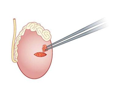 MicroTESE in Delhi for Male Infertility | Fertylity IVF