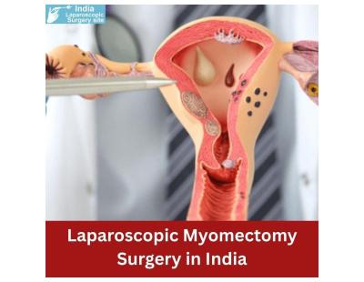 Laparoscopic Myomectomy Surgery in India