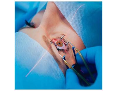 Experience Quality Care with the Best Laser Eye Treatment