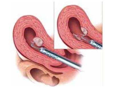Microtese in Delhi for Severe Male Infertility | Fertylity IVF