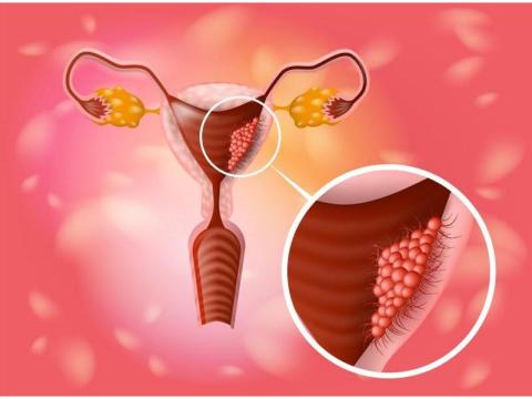 Best Care for Uterine Cancer Treatment in Noida by Specialists'