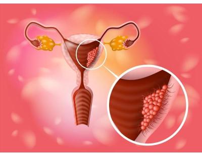 Best Care for Uterine Cancer Treatment in Noida by Specialists'
