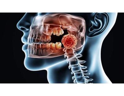 Advanced Oral Cancer Treatment with Comprehensive Patient Support