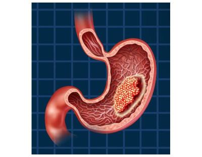Expert Solutions for Stomach Cancer Treatment in Noida