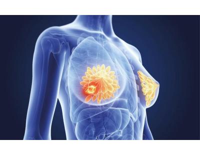 Best Breast Cancer Treatment in Noida by Dr Manish Singhal